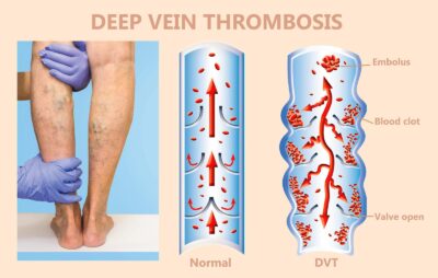 causes of deep vein thrombosis