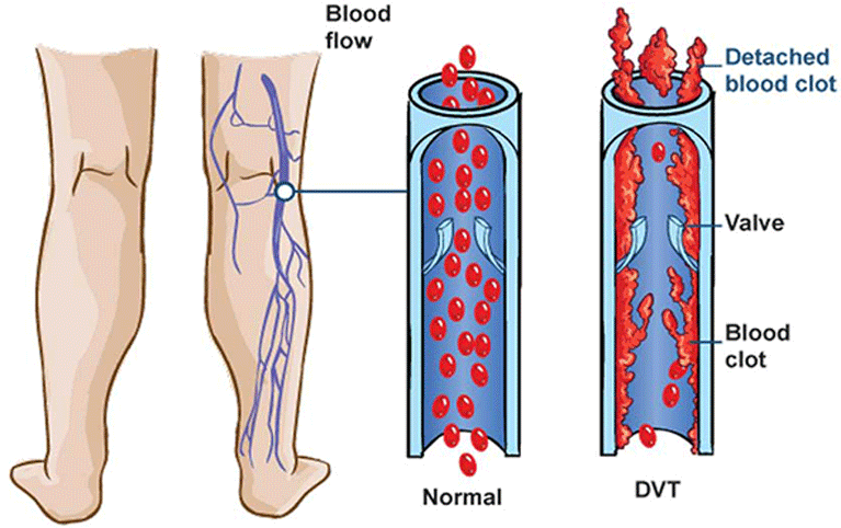 Deep Vein Thrombosis