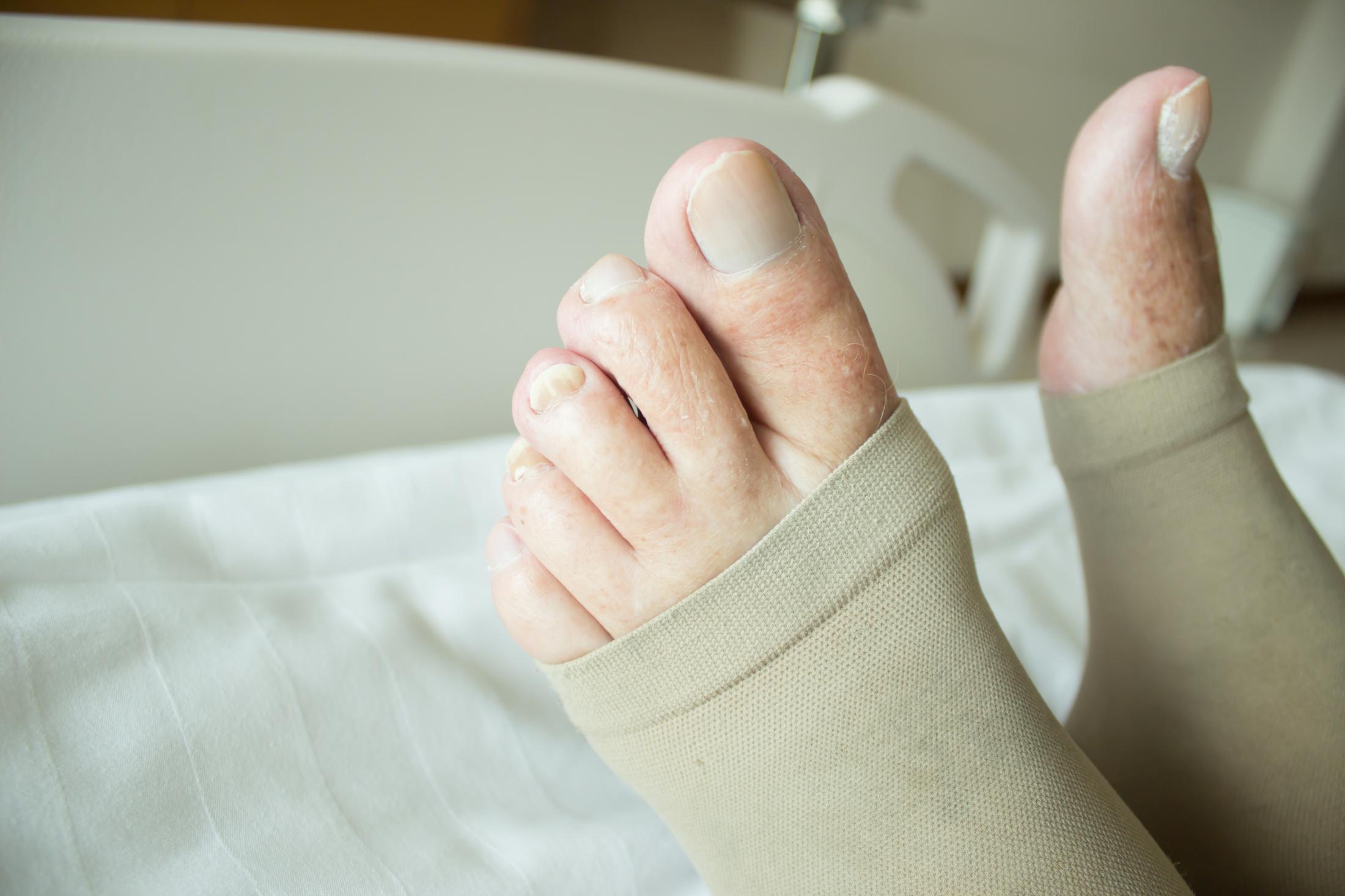 How Compression Therapy Supports Deep Vein Thrombosis Recovery