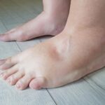 Edema and Swelling