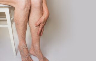 Compression Stockings for Varicose Veins and Venous Insufficiency