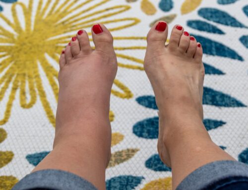 Managing Summer Swelling & Edema