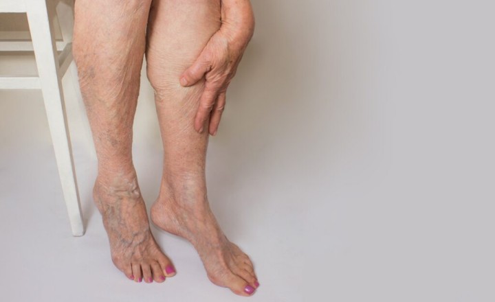 Vein Diseases