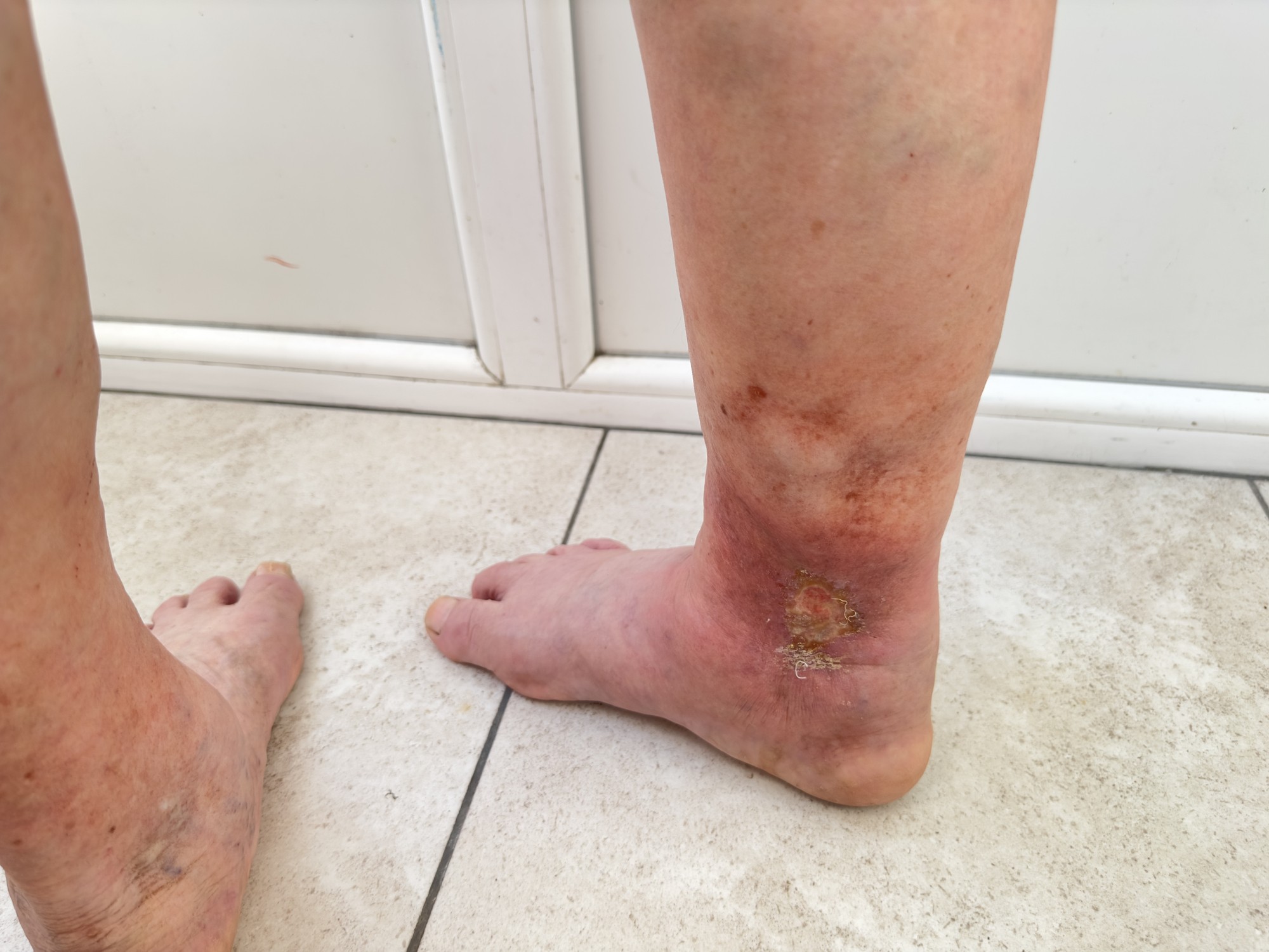 What Causes Venous Leg Ulcers?